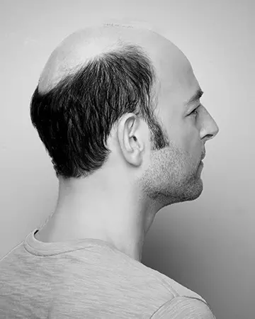   solutions before after mens gallery photos of mens hair loss solutions 07 mens hair loss solutions before and after 02