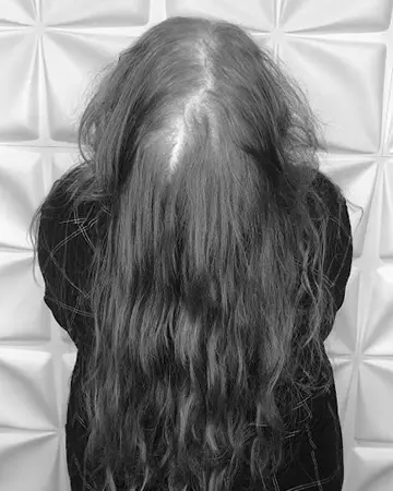   solutions before after womens gallery photos of womens hair loss solutions 14 womens hair loss solutions before and after 02