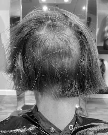   solutions before after womens gallery photos of womens hair loss solutions 15 womens hair loss solutions before and after 02