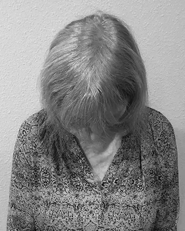   solutions before after womens gallery photos of womens hair loss solutions 16 womens hair loss solutions before and after 02