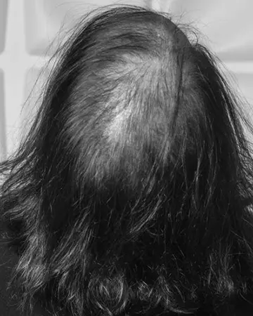   solutions before after womens gallery photos of womens hair loss solutions 21 womens hair loss solutions before and after 02