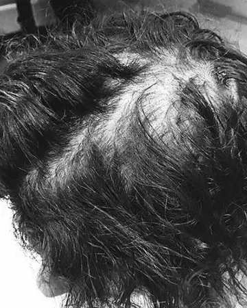   solutions before after womens gallery photos of womens hair loss solutions 26 womens hair loss solutions before and after 02