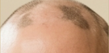 Alopecia awareness