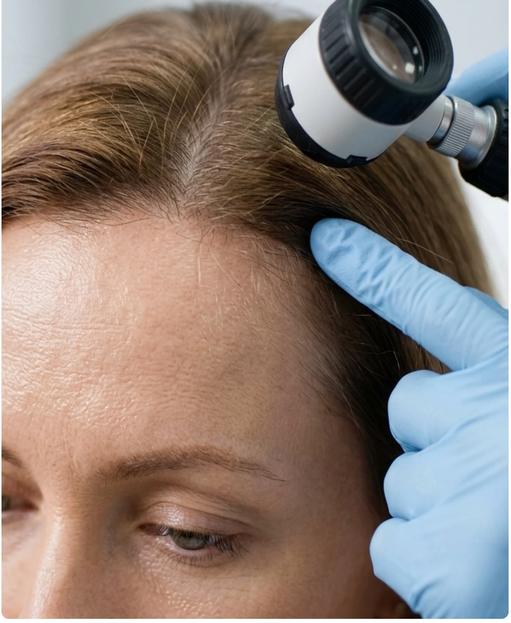 Scalp analysis of a woman's hairline with a dermatoscope