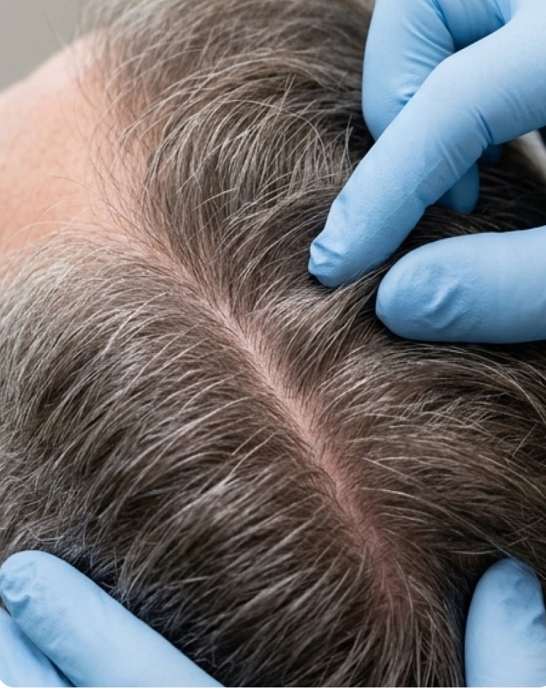 Gloved hands parting hair to examine the scalp