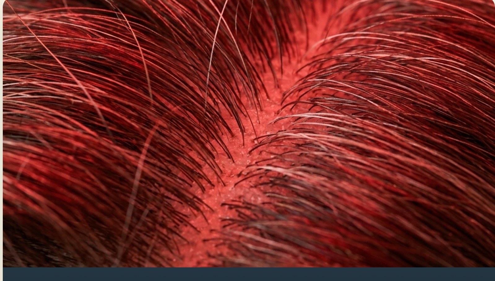 Scalp health and red light therapy